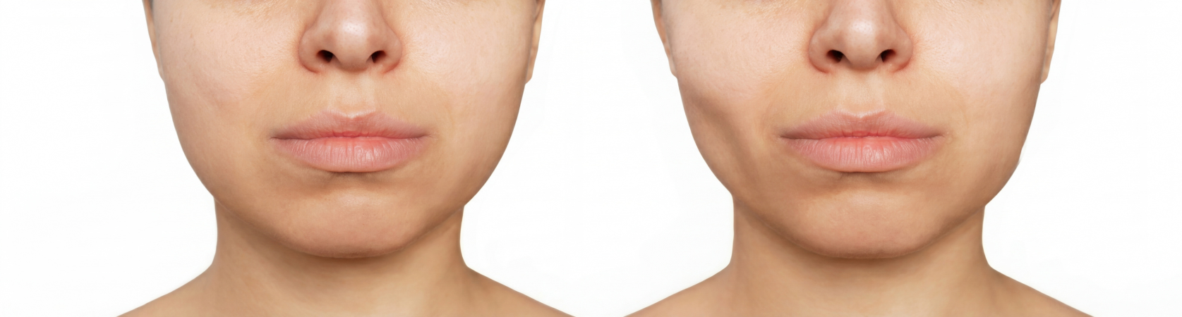 The Truth About Buccal Fat Removal: Is It Worth The Risk?