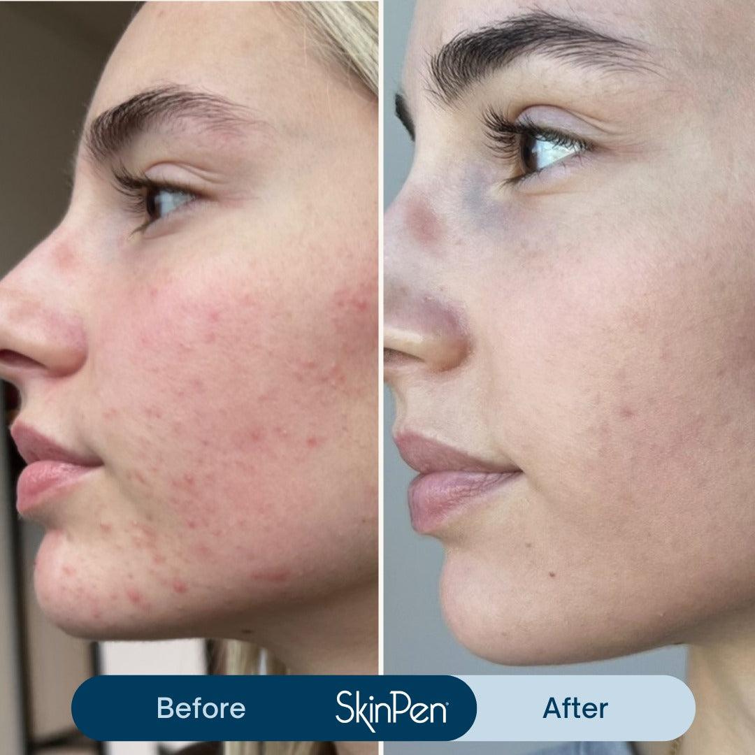 GMC SkinPen Advanced Needling Treatment Packages