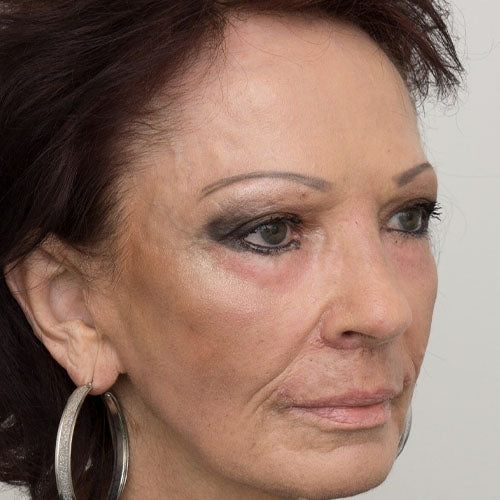 Brightening Laser Peel after treatment