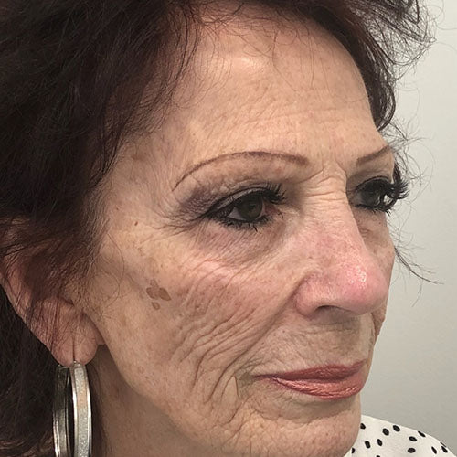 Brightening Laser Peel before treatment