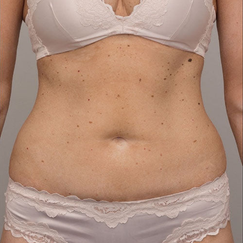 Evolvex Body Contouring after treatment