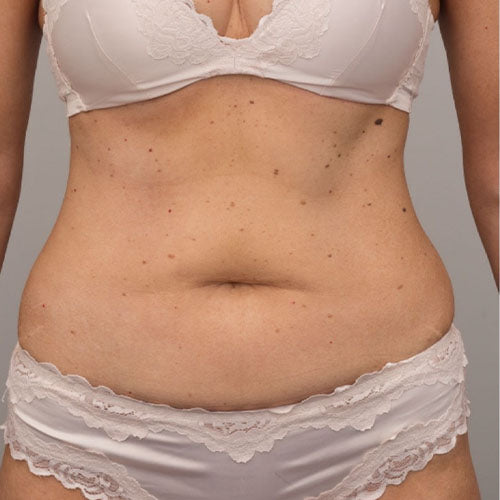 Evolvex Body Contouring before treatment