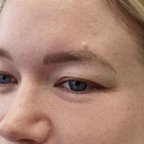 Fibroblast Plasma Pen after treatment