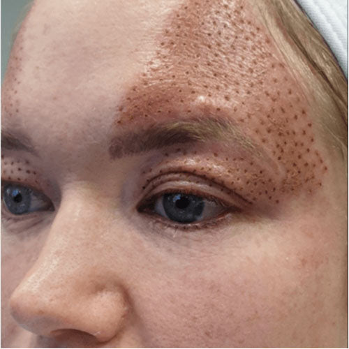 Fibroblast Plasma Pen before treatment