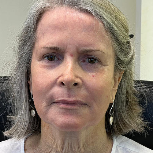 Laser Resurfacing after treatment