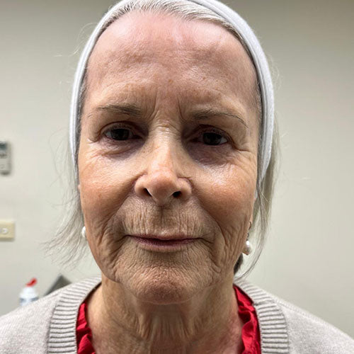 Laser Resurfacing before treatment