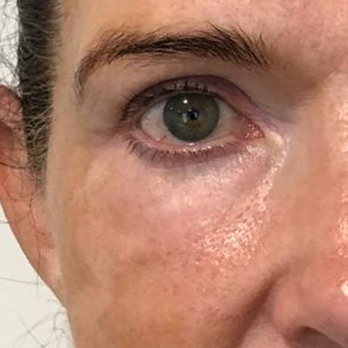 Morpheus8 Face after treatment