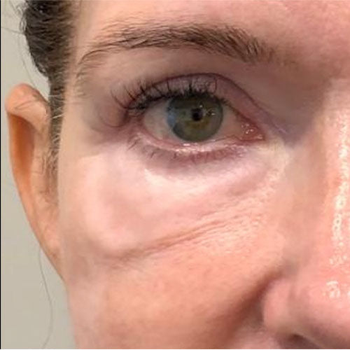 Morpheus8 Face before treatment