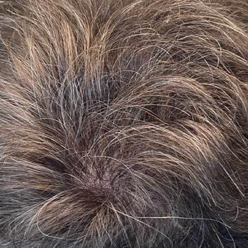 Hair Regrowth Programme after treatment