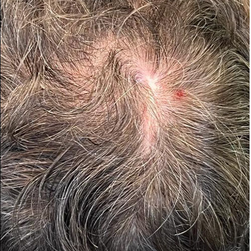 Hair Regrowth Programme before treatment