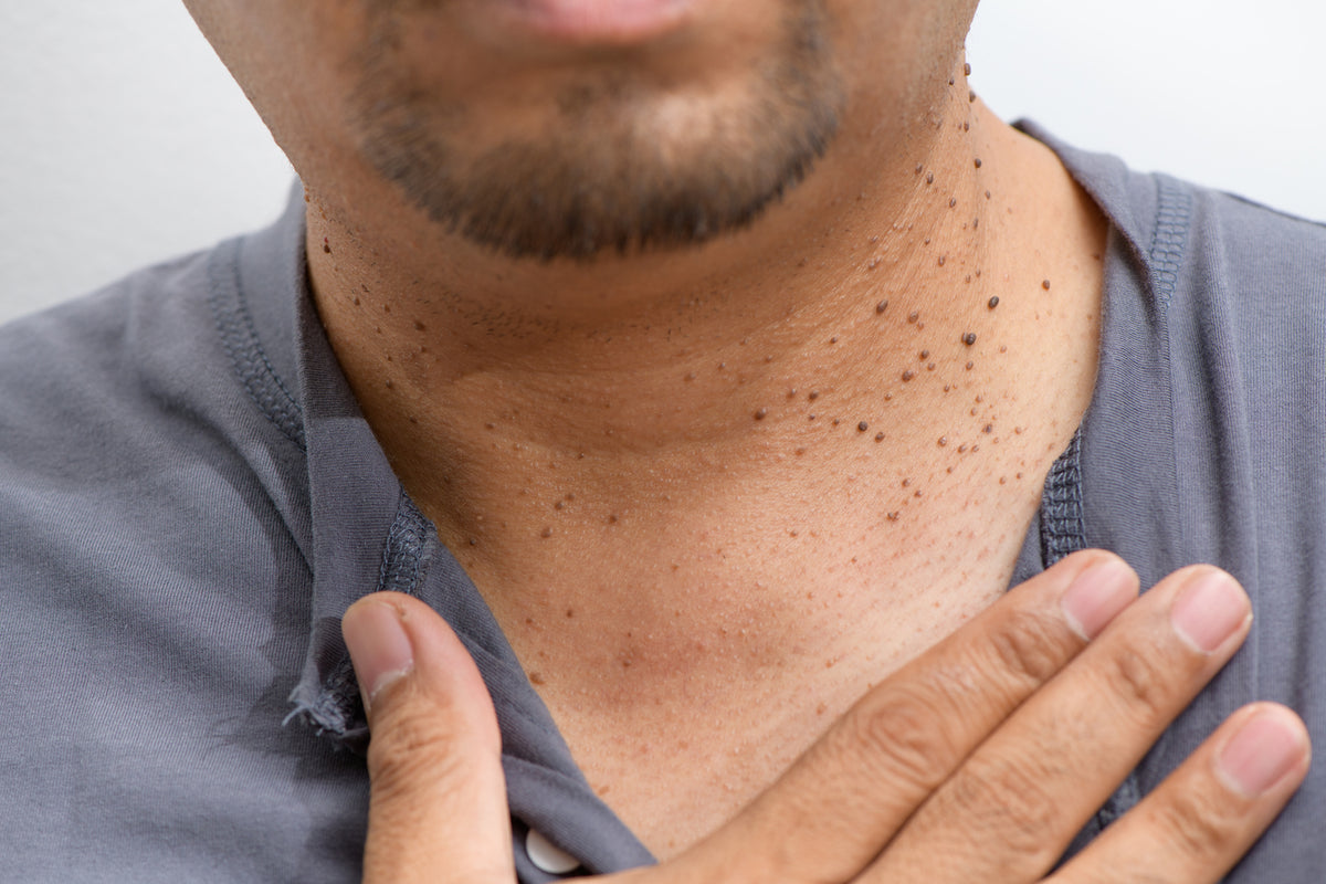Inverted Seb K Seborrheic Keratosis Removal (Seb K) – GMC Cosmedical